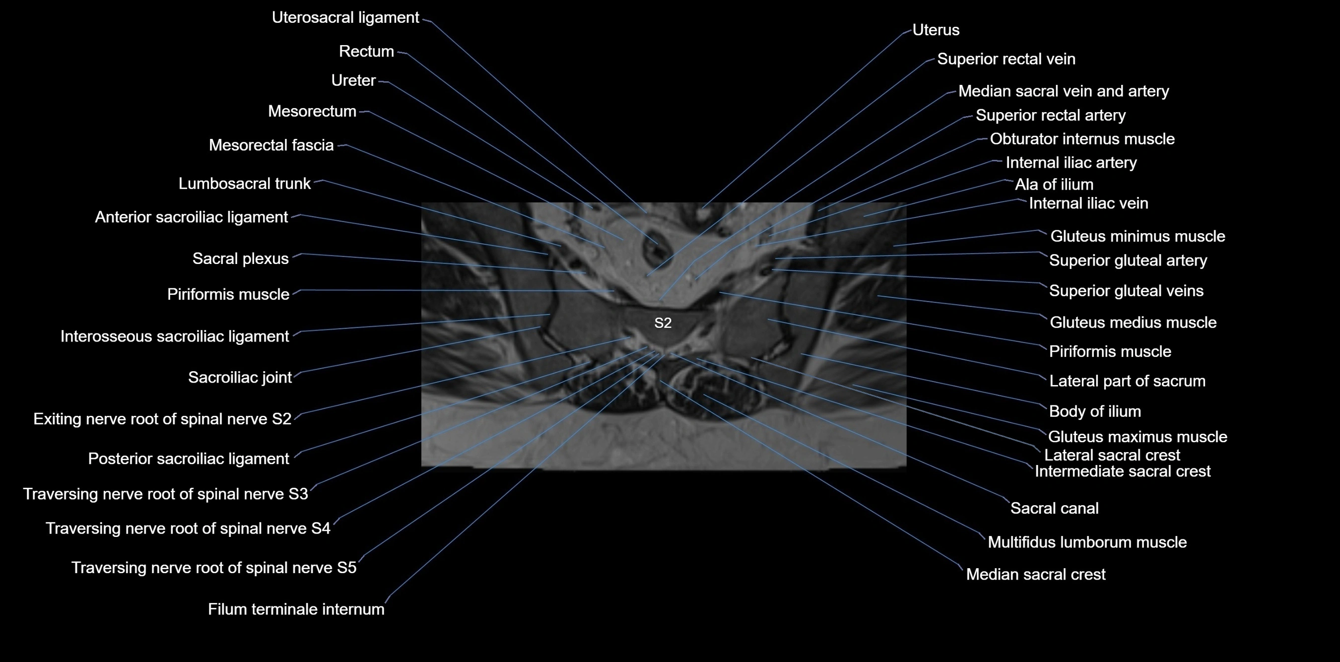 MRI sacrum, coccyx and sacroiliac joint axial cross sectional anatomy 3T  radiology  image-img-00001-00030.webp